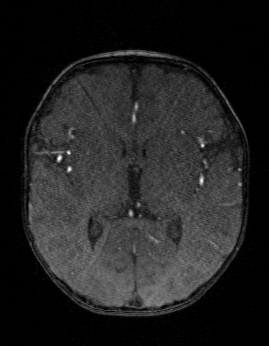 Occipital horn syndrome (Radiopaedia 14255-14129 MRA 85).jpg