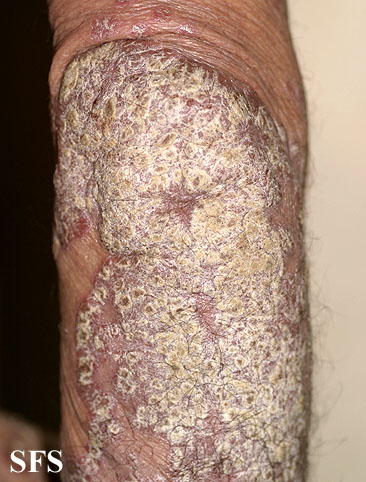 File:Psoriasis (Dermatology Atlas 31).jpg