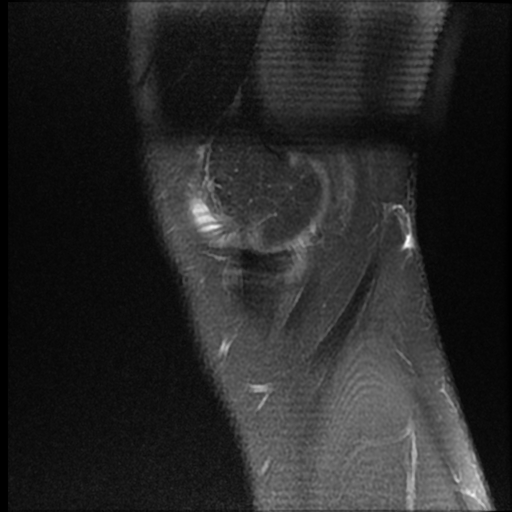 File:ACL acute full thickness tear - deep lateral femoral sulcus sign (Radiopaedia 38594-40740 Sagittal PD fat sat 2).jpg
