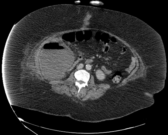 File:Abdominal abscess - pre and post percutaneous drainage (Radiopaedia 60209-67816 Axial 6).png