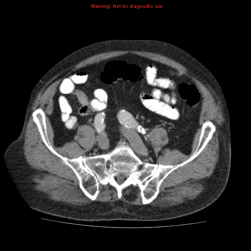 Abdominal aortic aneurysm (Radiopaedia 10122-10660 Axial C+ portal venous phase 58).jpg
