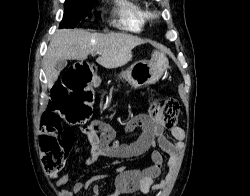 Abdominal aortic aneurysm (Radiopaedia 67117-76452 Coronal C+ arterial phase 5).jpg