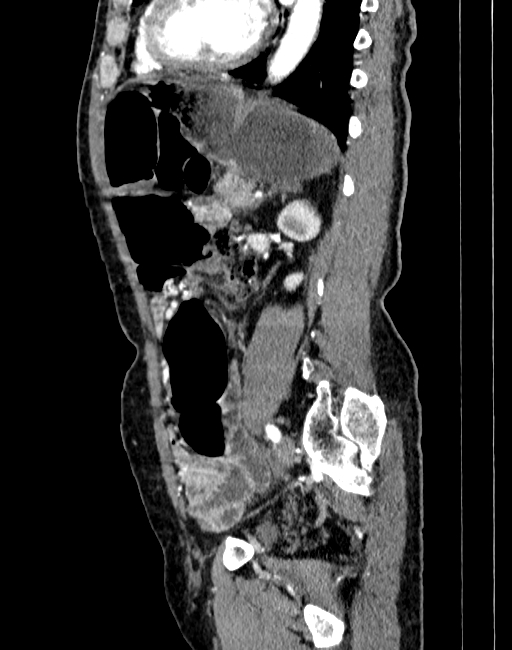 Abdominal aortic aneurysm (Radiopaedia 83581-98689 Sagittal C+ arterial phase 75).jpg