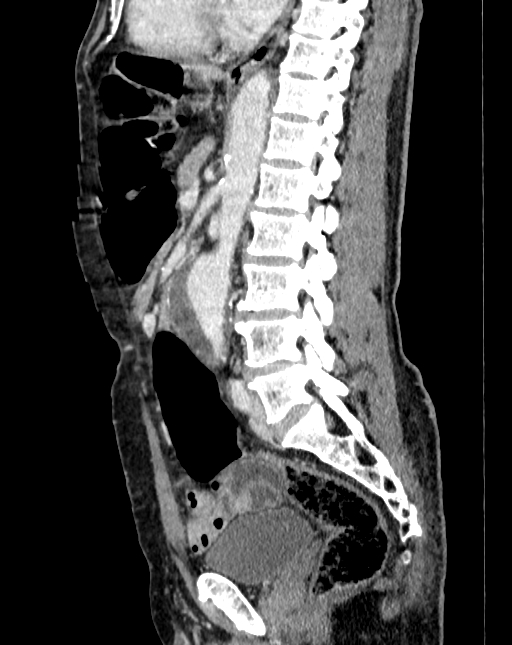 Abdominal aortic aneurysm (Radiopaedia 83581-98689 Sagittal C+ portal venous phase 59).jpg