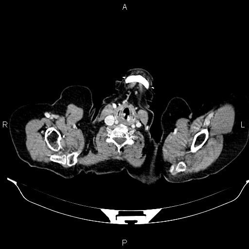 File:Abdominal aortic aneurysm (Radiopaedia 85063-100606 Axial C+ portal venous phase 2).jpg