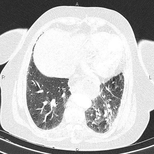 Abdominal aortic aneurysm (Radiopaedia 85063-100606 Axial lung window 47).jpg