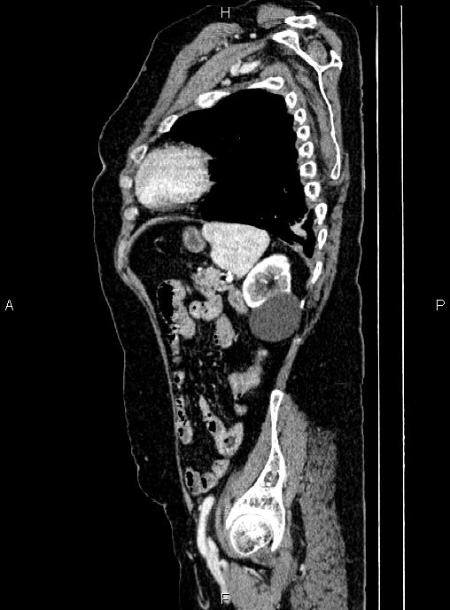 Abdominal aortic aneurysm (Radiopaedia 85063-100606 Sagittal C+ arterial phase 65).jpg