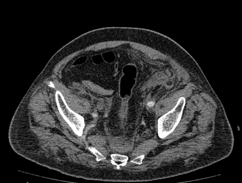 Abdominal aortic aneurysm rupture (Radiopaedia 54179-60362 Axial C+ arterial phase 48).jpg
