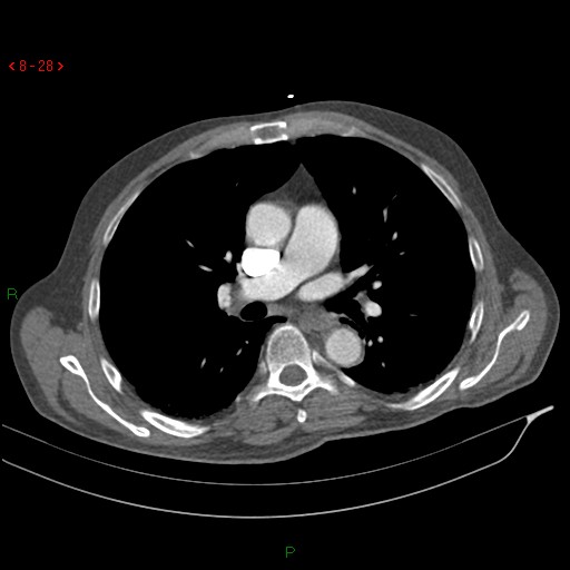 File:Abdominal aortic aneurysm rupture with aortocaval fistula (Radiopaedia 14897-14841 Axial C+ arterial phase 28).jpg