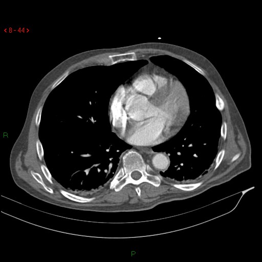 Abdominal aortic aneurysm rupture with aortocaval fistula (Radiopaedia 14897-14841 Axial C+ arterial phase 44).jpg