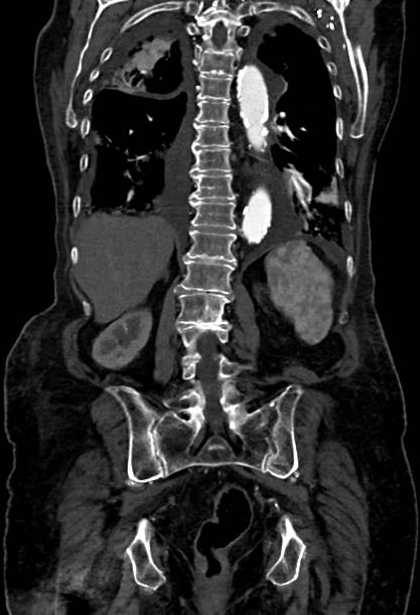 Abdominal aortic aneurysm with thrombus fissuration (Radiopaedia 73192-83919 Coronal C+ arterial phase 65).jpg