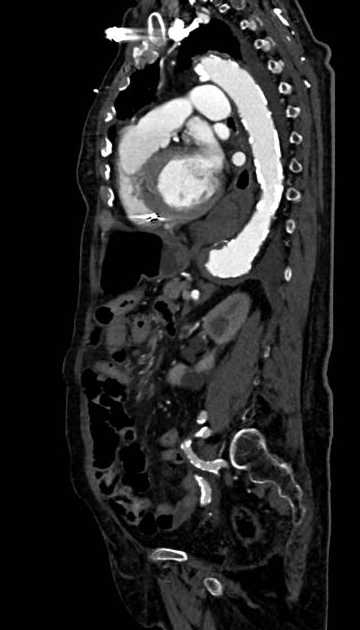 Abdominal aortic aneurysm with thrombus fissuration (Radiopaedia 73192-83919 Sagittal C+ arterial phase 50).jpg