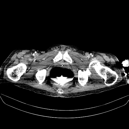 File:Abdominal collection due to previous cecal perforation (Radiopaedia 80831-94320 Axial C+ portal venous phase 212).jpg