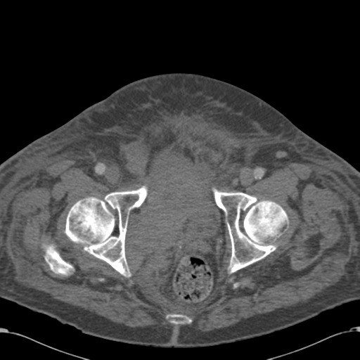 Abdominal hematoma (Radiopaedia 33614-34715 Axial C+ portal venous phase 126).png
