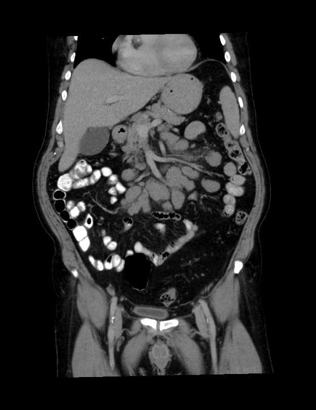 Abdominal lymphoma - with sandwich sign (Radiopaedia 53486-59492 C+ portal venous phase 37).jpg