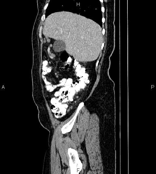 Abdominal lymphoma with sandwich sign (Radiopaedia 84378-99704 Sagittal C+ portal venous phase 12).jpg
