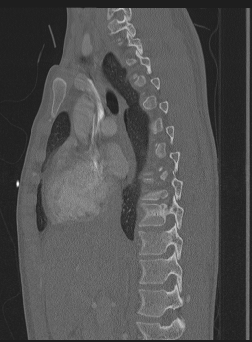 Abdominal multi-trauma - devascularised kidney and liver, spleen and pancreatic lacerations (Radiopaedia 34984-36486 Sagittal bone window 43).png