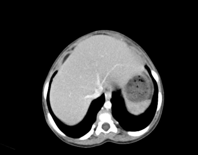 Abdominal premesenteric cystic lymphangioma (Radiopaedia 82995-97350 Axial C+ portal venous phase 3).jpg