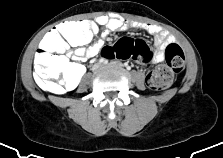 Abdominal wall and retroperitoneal tuberculosis (Radiopaedia 88137-104729 Axial C+ portal venous phase 114).jpg