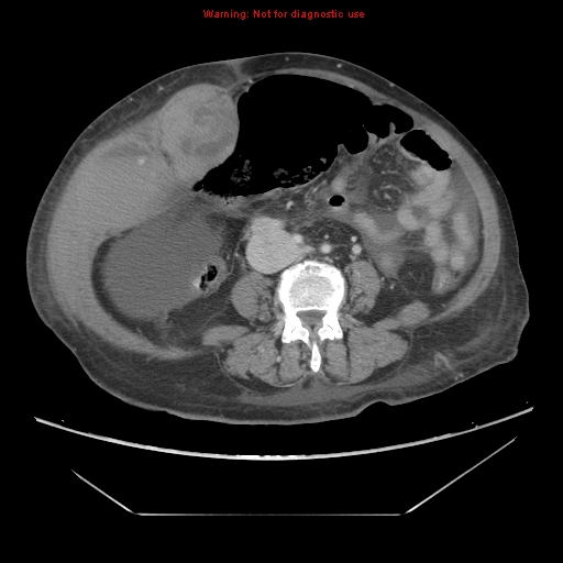 File:Abdominal wall hematoma (Radiopaedia 9427-10112 Axial C+ portal venous phase 62).jpg