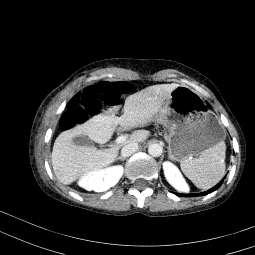 Abdominal wall hematoma with active bleeding (Radiopaedia 83915-99117 Axial C+ portal venous phase 2).jpg