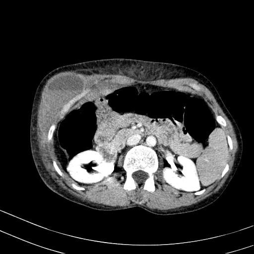 File:Abdominal wall hematoma with active bleeding (Radiopaedia 83915-99117 Axial C+ portal venous phase 22).jpg