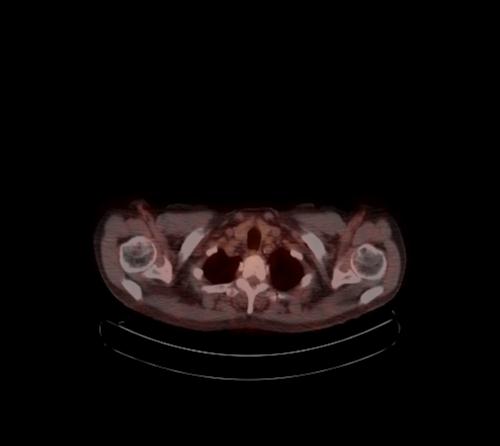 Abdominal wall metastasis from colorectal carcinoma (Radiopaedia 31016-31719 C 127).jpg