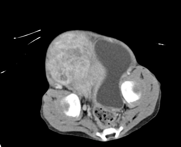 Abdominopelvic rhabdomyosarcoma (Radiopaedia 78356-90984 Axial C+ portal venous phase 140).jpg