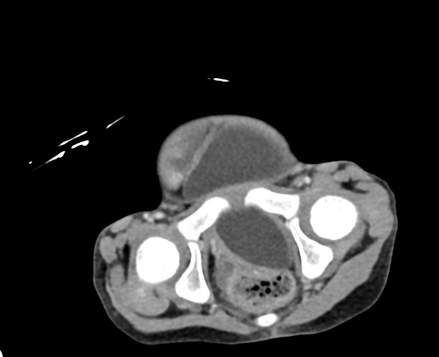Abdominopelvic rhabdomyosarcoma (Radiopaedia 78356-90984 Axial C+ portal venous phase 149).jpg