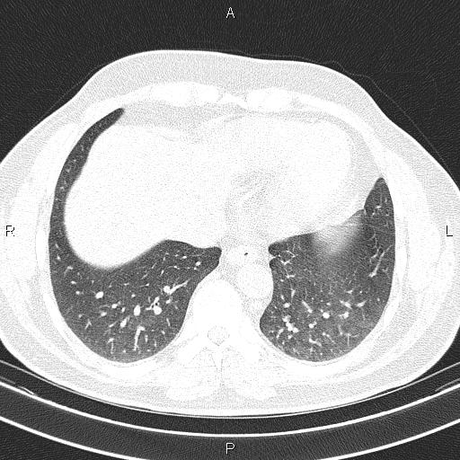 Aberrant right subclavian artery (Radiopaedia 87093-103354 Axial lung window 83).jpg