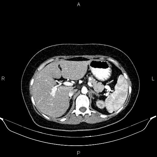 Aberrant right subclavian artery (Radiopaedia 87334-103629 Axial C+ arterial phase 70).jpg