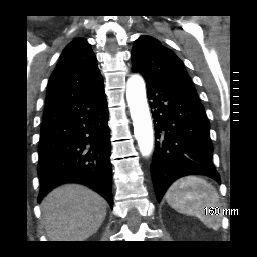 File:Aberrant right subclavian artery stenosis (Radiopaedia 52656-58670 B 63).jpg