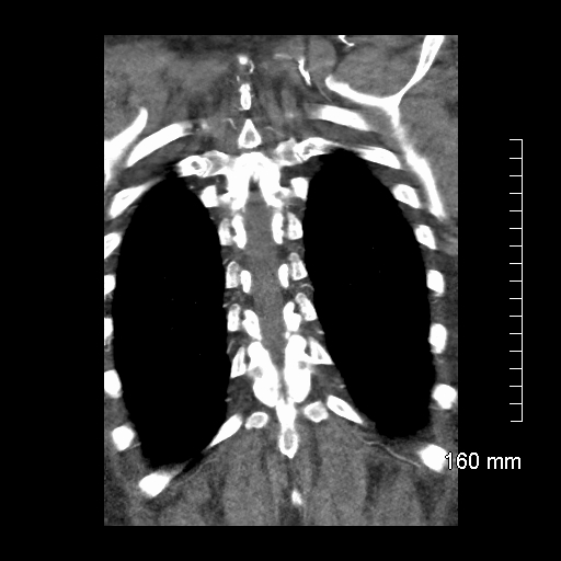 Aberrant right subclavian artery stenosis (Radiopaedia 52656-58670 B 72).jpg
