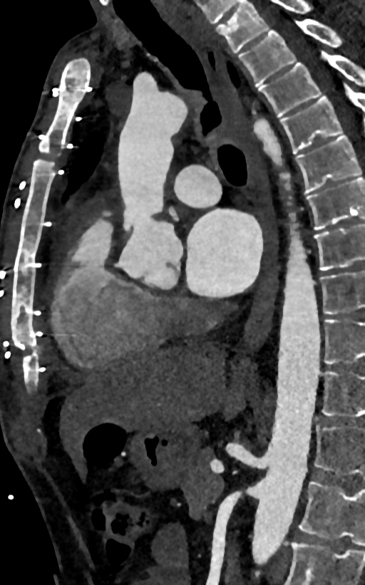 Accessory left atrial appendage (Radiopaedia 81987-95968 Sagittal C+ arterial phase 60).jpg