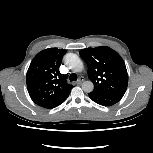 Accessory left horizontal fissure with lingular pneumonia (Radiopaedia 53763-59843 Axial C+ CTPA 33).jpg