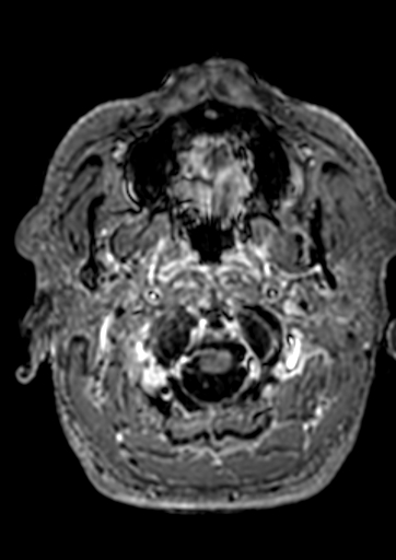 Accessory middle cerebral artery (Radiopaedia 73114-83828 Axial T1 C+ 196).jpg