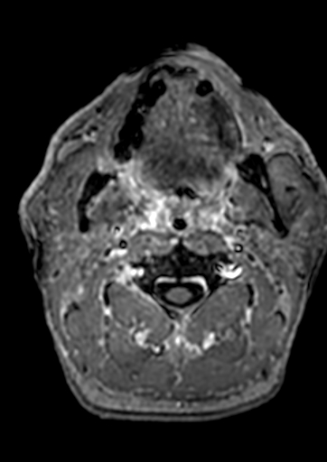File:Accessory middle cerebral artery (Radiopaedia 73114-83828 Axial T1 C+ 253).jpg