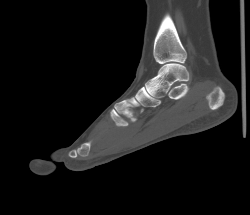 File:Accessory navicular bone (Radiopaedia 54999-61314 Sagittal non-contrast 57).jpg
