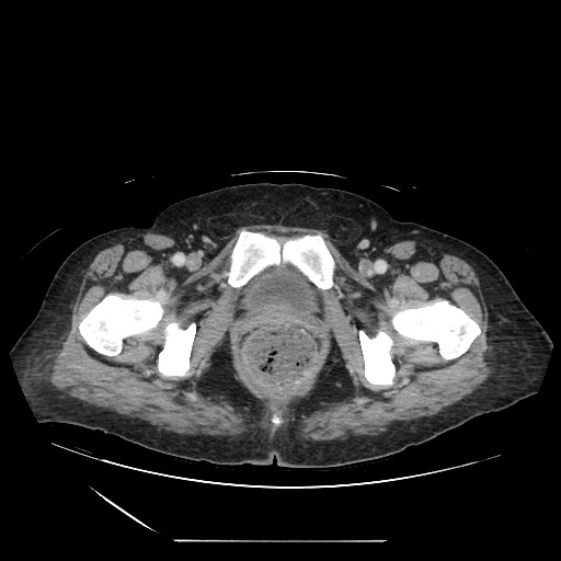 Acinar cell carcinoma of the pancreas (Radiopaedia 75442-86669 Axial C+ portal venous phase 146).jpg