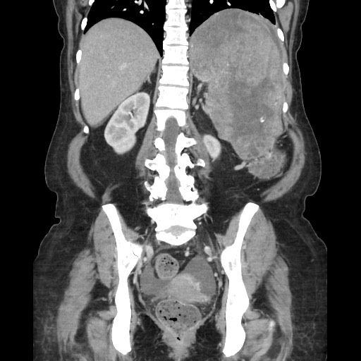 Acinar cell carcinoma of the pancreas (Radiopaedia 75442-86669 Coronal C+ portal venous phase 88).jpg