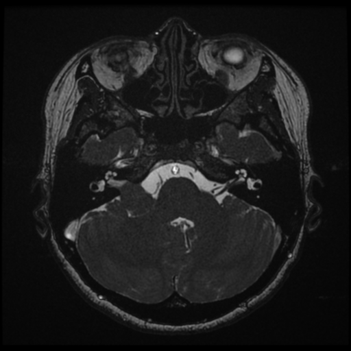 File:Acoustic neuroma (Radiopaedia 34049-35283 Axial 50).png