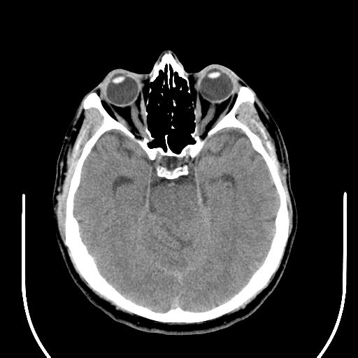 File:Acoustic schwannoma (Radiopaedia 29488-29982 AXIAL THICK non-contrast 18).jpg