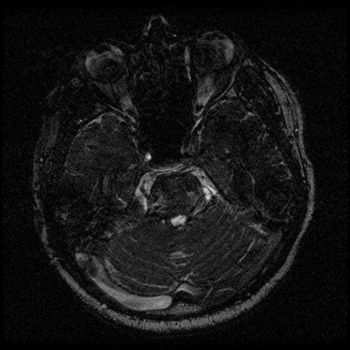 File:Acoustic schwannoma (Radiopaedia 33045-34060 Axial T2 54).png