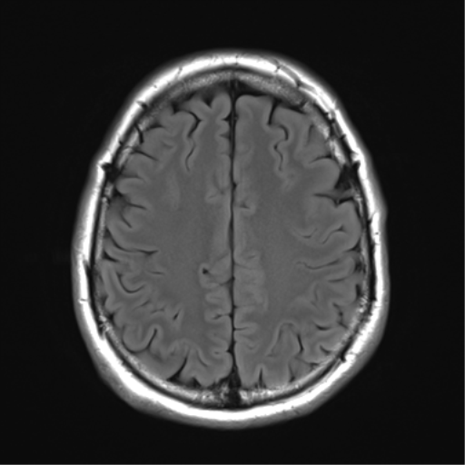 File:Acoustic schwannoma (Radiopaedia 50846-56358 Axial FLAIR 24).png