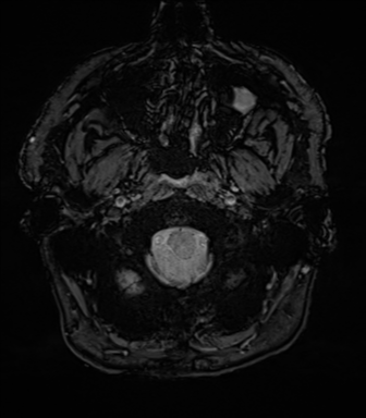 Acoustic schwannoma (Radiopaedia 50846-56358 Axial SWI 7).png