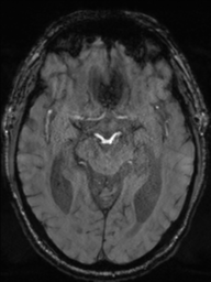 File:Acoustic schwannoma (Radiopaedia 55729-62281 Axial SWI 22).png