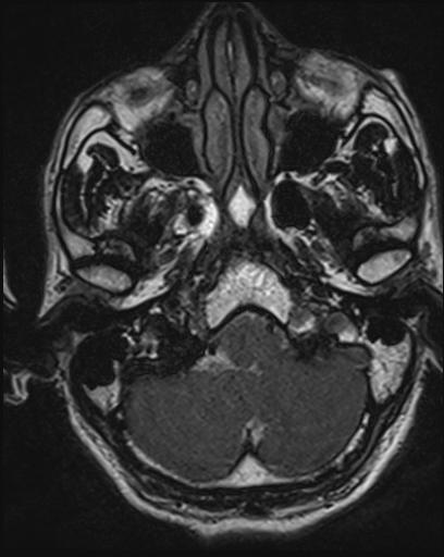 Acoustic schwannoma - probable (Radiopaedia 20386-20292 Axial T1 24).jpg