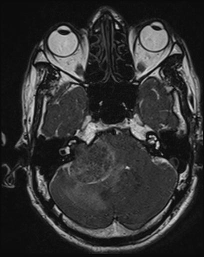 Acoustic schwannoma - probable (Radiopaedia 20386-20292 Axial T1 37).jpg