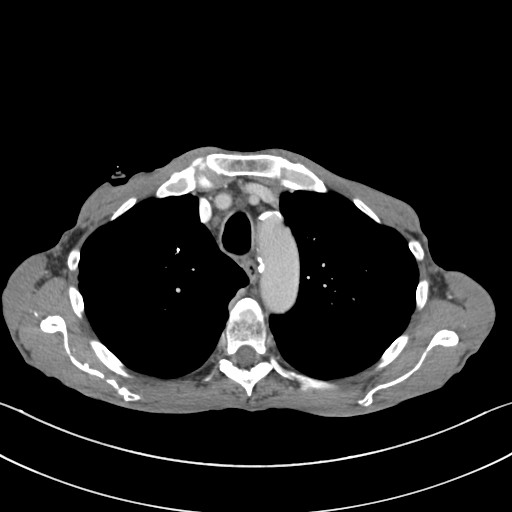 File:Acquired tracheoesophageal fistula (Radiopaedia 57747-65042 Axial C+ portal venous phase 24).jpg