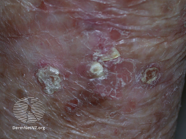 File:Actinic Keratoses affecting the legs and feet (DermNet NZ lesions-ak-legs-507).jpg
